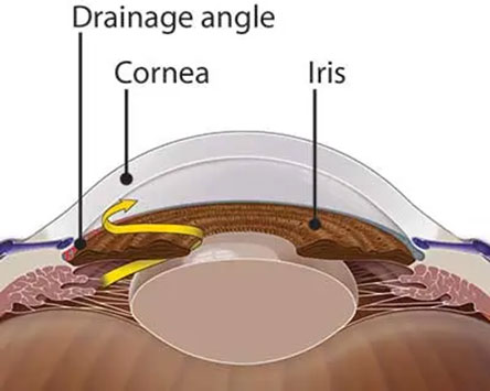 Glaucoma Symptoms